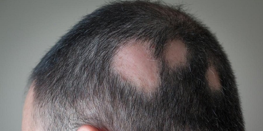 Alopecia Areata Treatment in Riyadh & Saudi Arabia Benefit