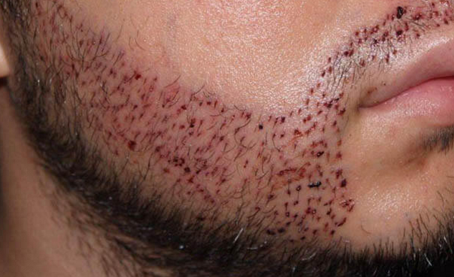 Beard Hair Transplant in Riyadh & Saudi Arabia Price