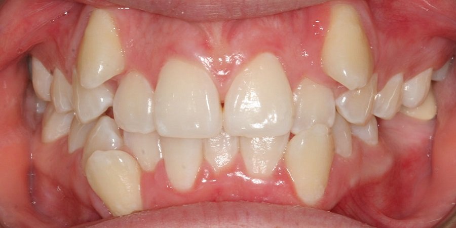 Crooked Teeth Treatment in Riyadh & Saudi Arabia Riyadh
