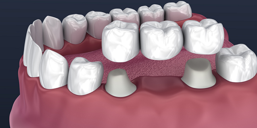 Dental Crown and Bridges in Riyadh & Saudi Arabia