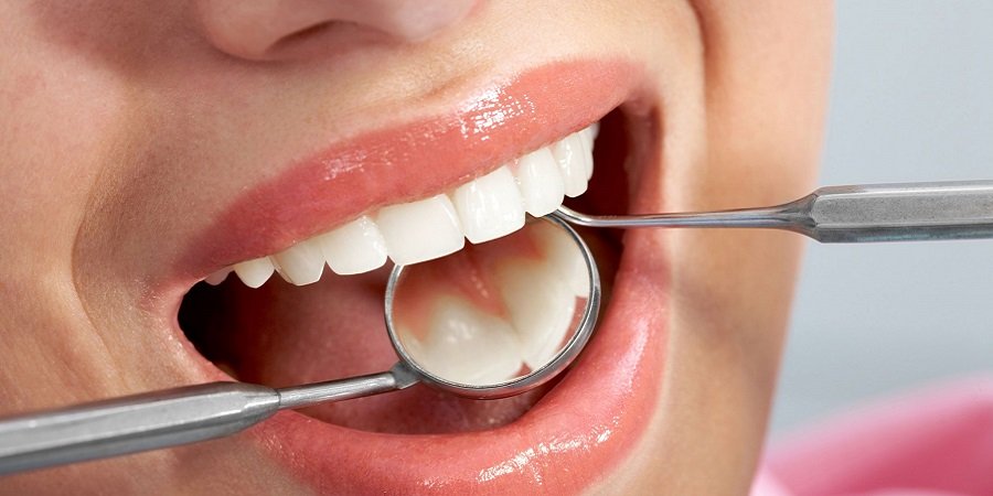 Tooth Filling Treatment in Riyadh & Saudi Arabia