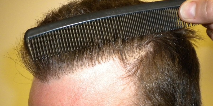 FUE Hair Transplant in Riyadh & Saudi Arabia Cost