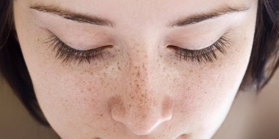 Freckles and Blemishes in Riyadh & Saudi Arabia Cost