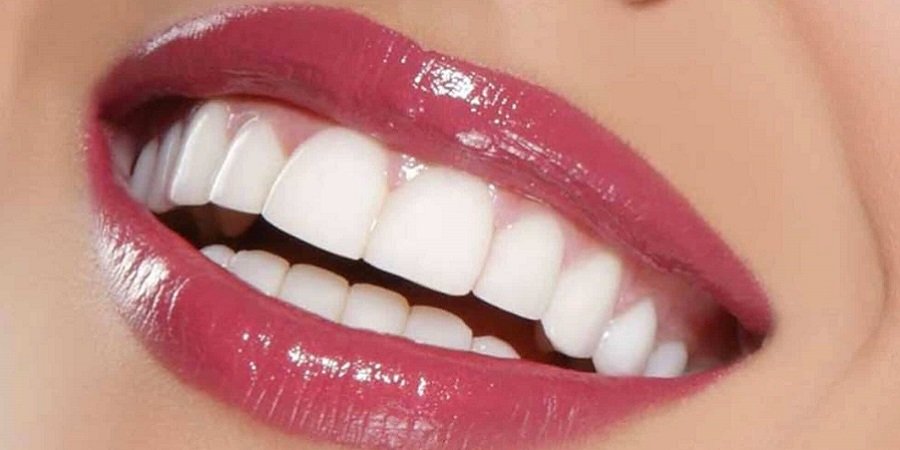 Hollywood Smile Design in Riyadh & Saudi Arabia Aesthetic