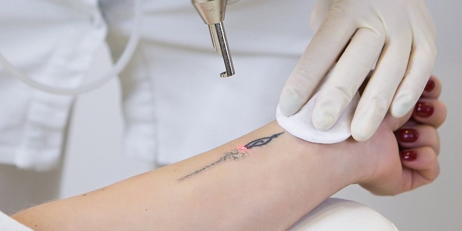 Laser Tattoo Removal in Riyadh Saudi Arabia Benefit