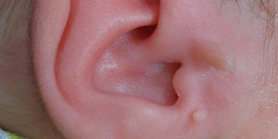 Preauricular Tag Removal in Riyadh & Saudi Arabia Cost