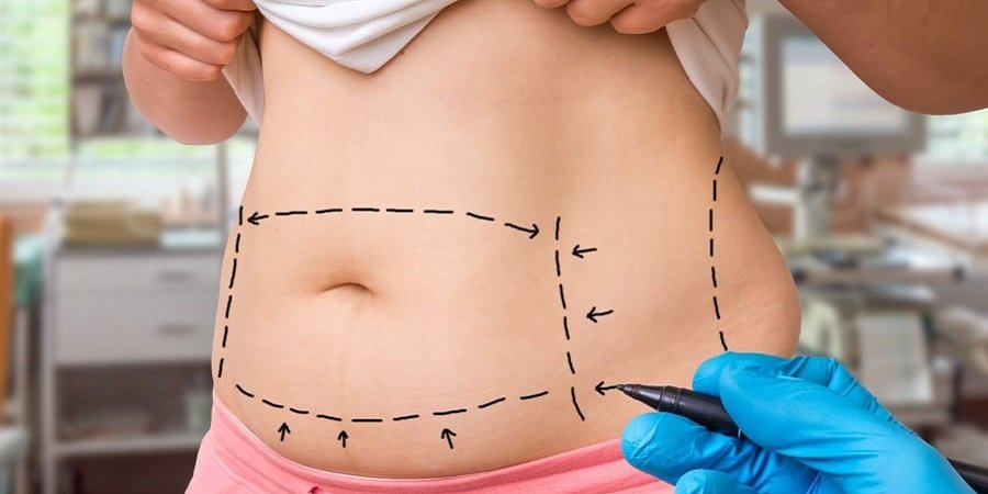 SculpSure Body Contouring in Riyadh & Saudi Arabia Clinic