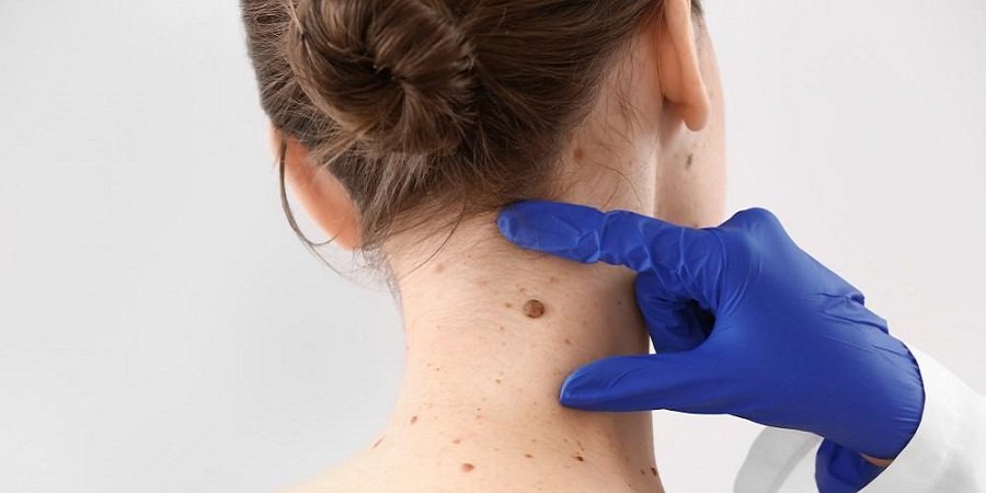 Skin Tag Removal in Riyadh & Saudi Arabia Aesthetic Clinic