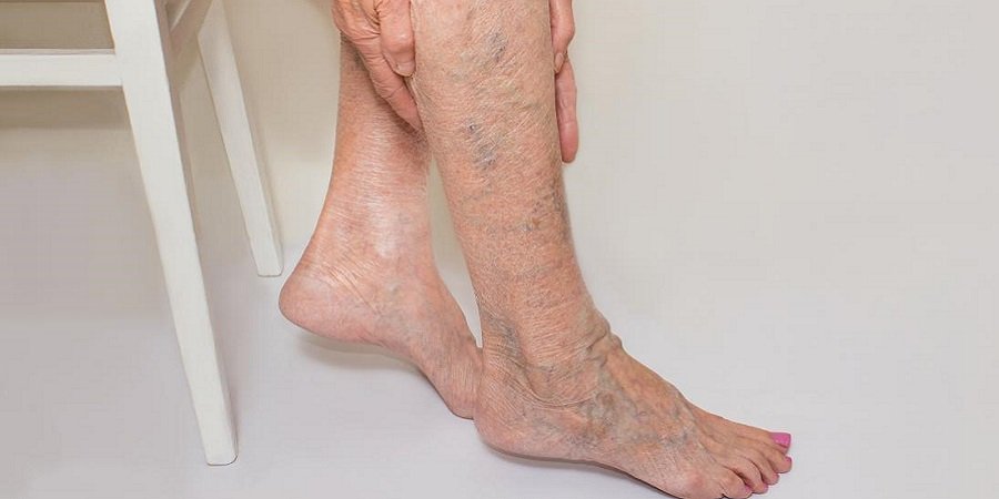 Spider Veins Treatment in Riyadh & Saudi Arabia Riyadh