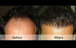 Best Hair Transplant Cost in Riyadh