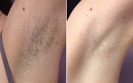 Best Laser Hair Removal Cost in Riyadh