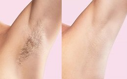 Best Laser Hair Removal in Riyadh