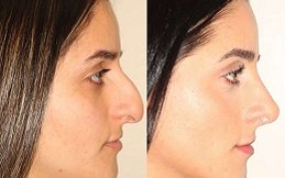 Best Rhinoplasty Cost in Riyadh