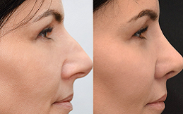 Best Rhinoplasty in Riyadh