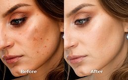 Best Skin Whitening in Riyadh