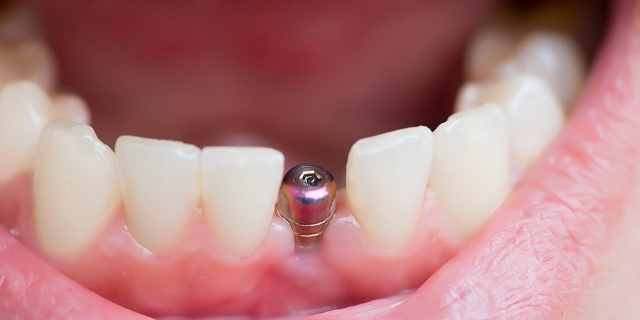 Dental Implants in Riyadh & Saudi Arabia Implants Cost