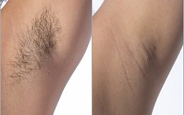 Laser Hair Removal in Riyadh