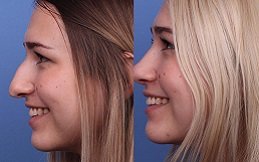 Rhinoplasty cost in riyadh