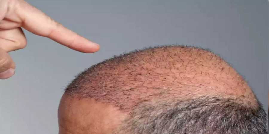 Hair Transplant in Buraydah & Al Qassim