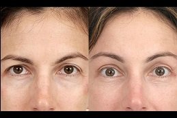 Best Brow Lift Surgery Clinic in Riyadh