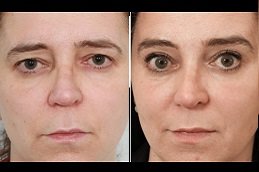 Best Brow Lift Surgery cost in Riyadh