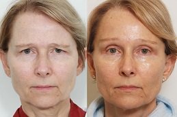 Best Brow Lift Surgery in Riyadh