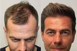 Best FUE Hair Transplant Clinic in Riyadh