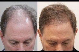 Best FUE Hair Transplant cost in Riyadh