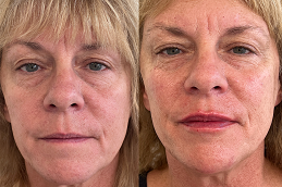 Best Juvederm Treatment cost in Riyadh