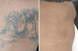 Best Laser Tattoo Removal Clinic in Riyadh