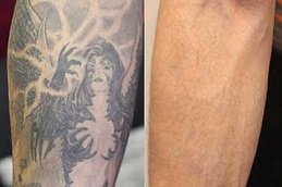 Best Laser Tattoo Removal cost in Riyadh