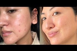 Best Pimples Treatment cost in Riyadh