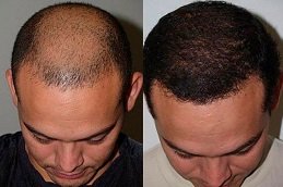 Best Scarless Hair Transplant in riyadh