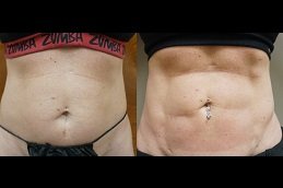 Best Vaser 4D Liposuction cost in Riyadh