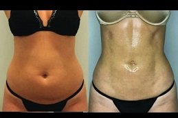 Best Vaser 4D Liposuction in riyadh