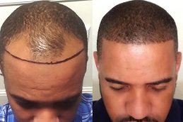 FUE Hair Transplant cost in riyadh