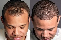 FUE Hair Transplant in Riyadh