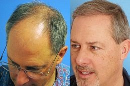 Hair Transplant Clinic Jeddah