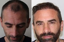 Hair Transplant in Jeddah