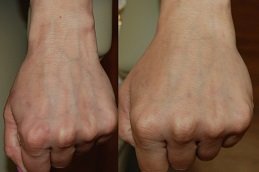 Hand Rejuvenation cost in riyadh