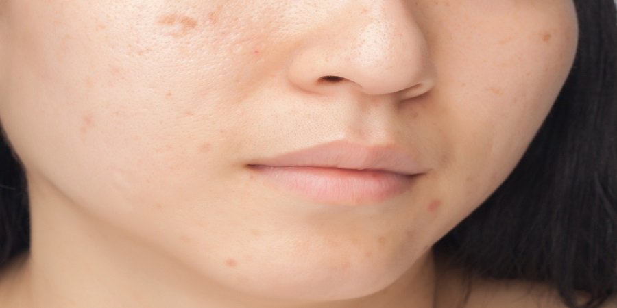 How to get rid of red marks from acne