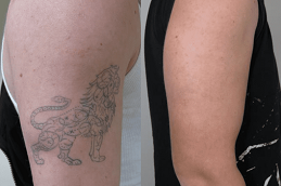 Laser Tattoo Removal in Riyadh