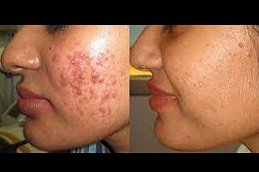 Pimples Treatment in riyadh