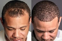 Scarless Hair Transplant cost in riyadh