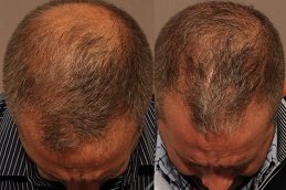 Scarless Hair Transplant in riyadh