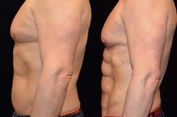 Six Pack Abs Surgery Clinic Riyadh