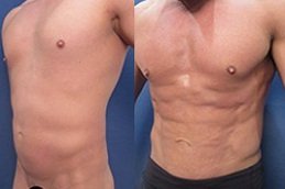 Six Pack Abs Surgery in Riyadh