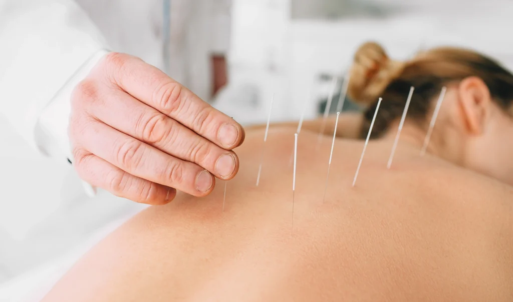 Best Acupuncture Treatment in Riyadh & Saudi Arabia