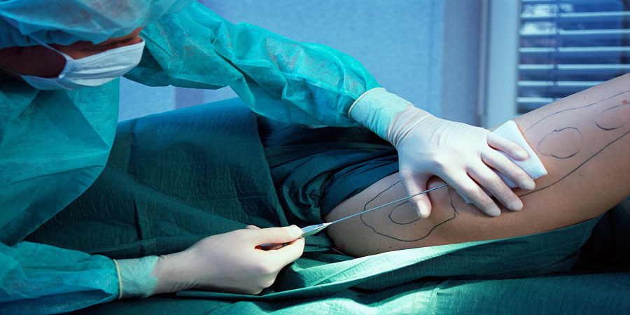 Liposuction Surgery Cost in Riyadh