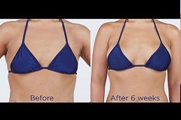 Best Breast Fillers Injections in Riyadh